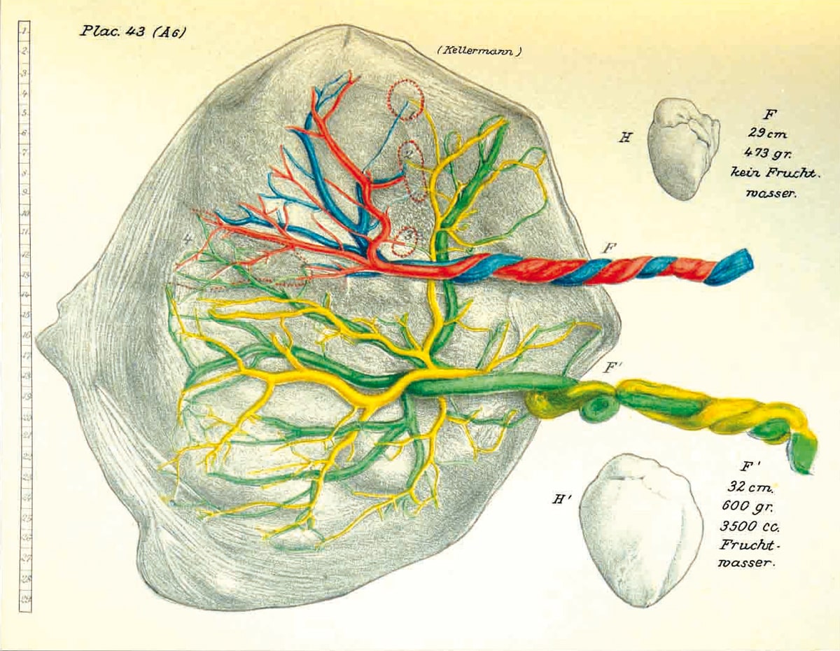 Twin placenta with vessel connections, Schatz 1898