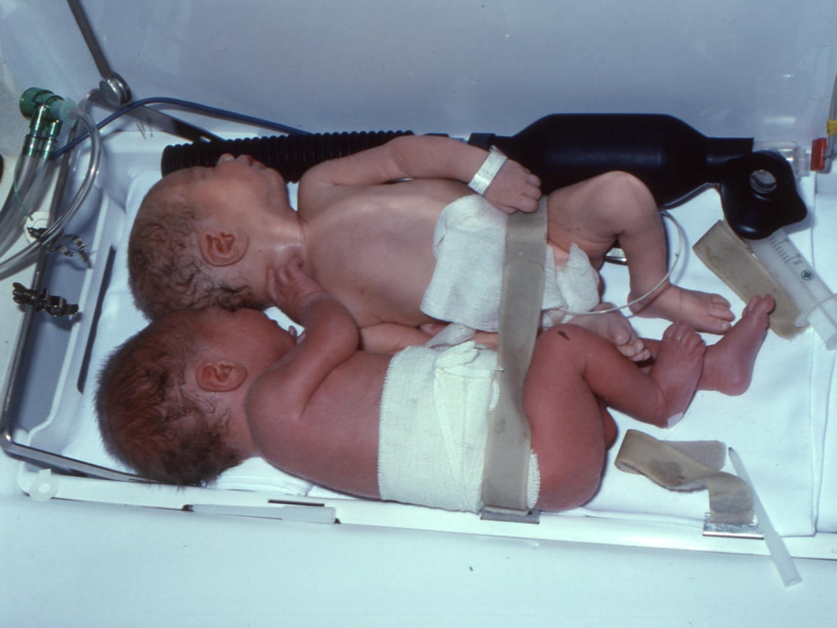 Feto-fetal transfusion